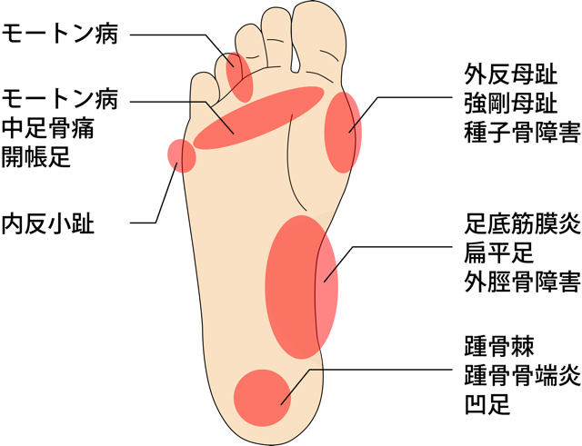 足底筋膜炎の説明図